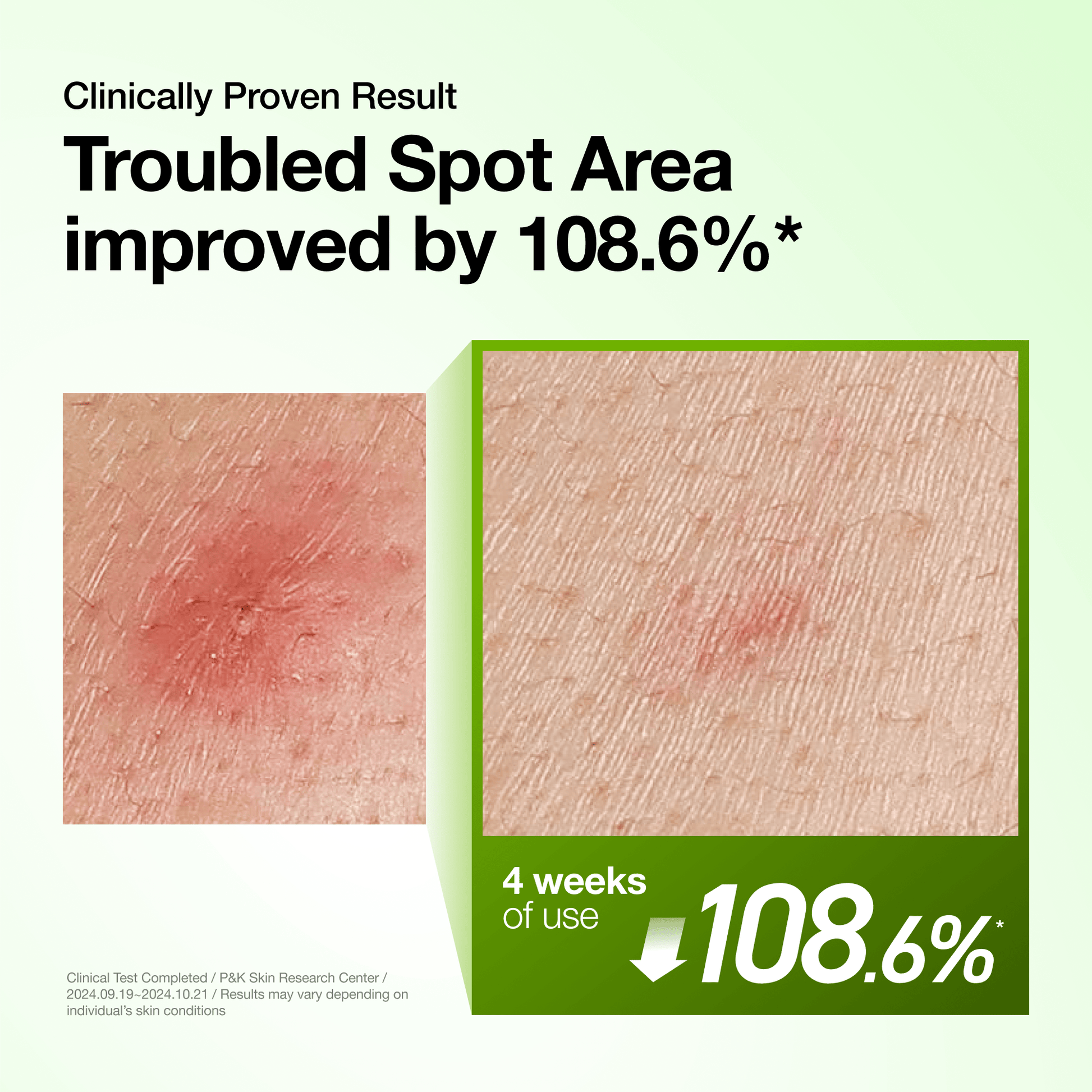Anua Azelaic Acid 10 Hyaluron Redness Soothing Serum - results